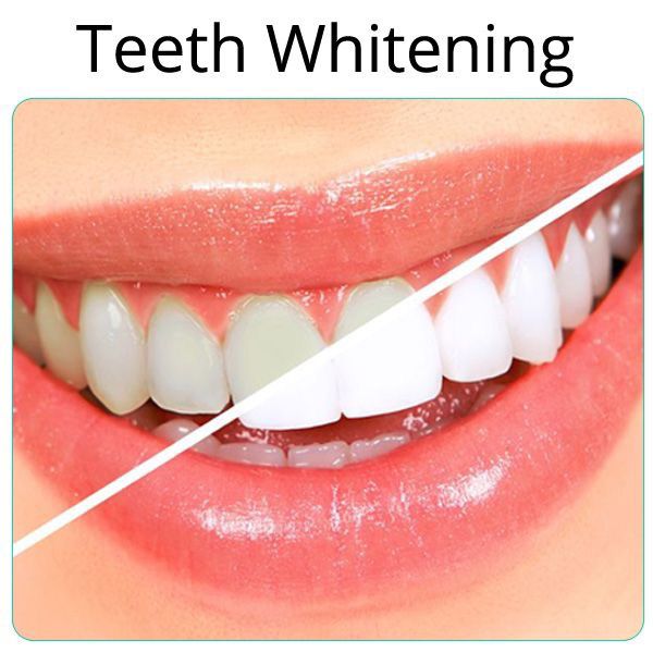 Teeth Whitening Treatment